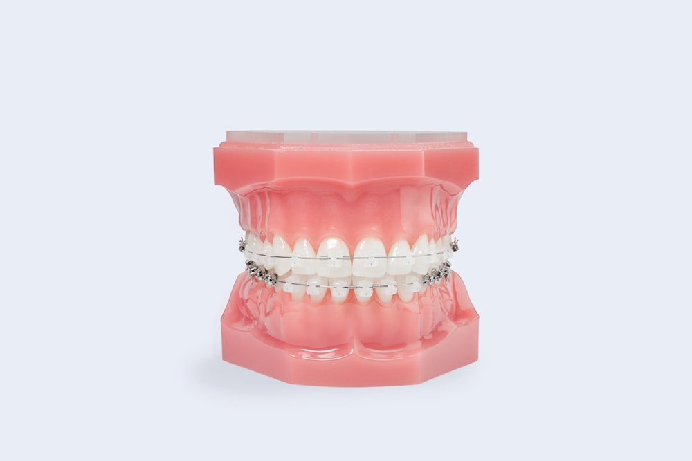 Types of Braces in Kingston & Hudson NY