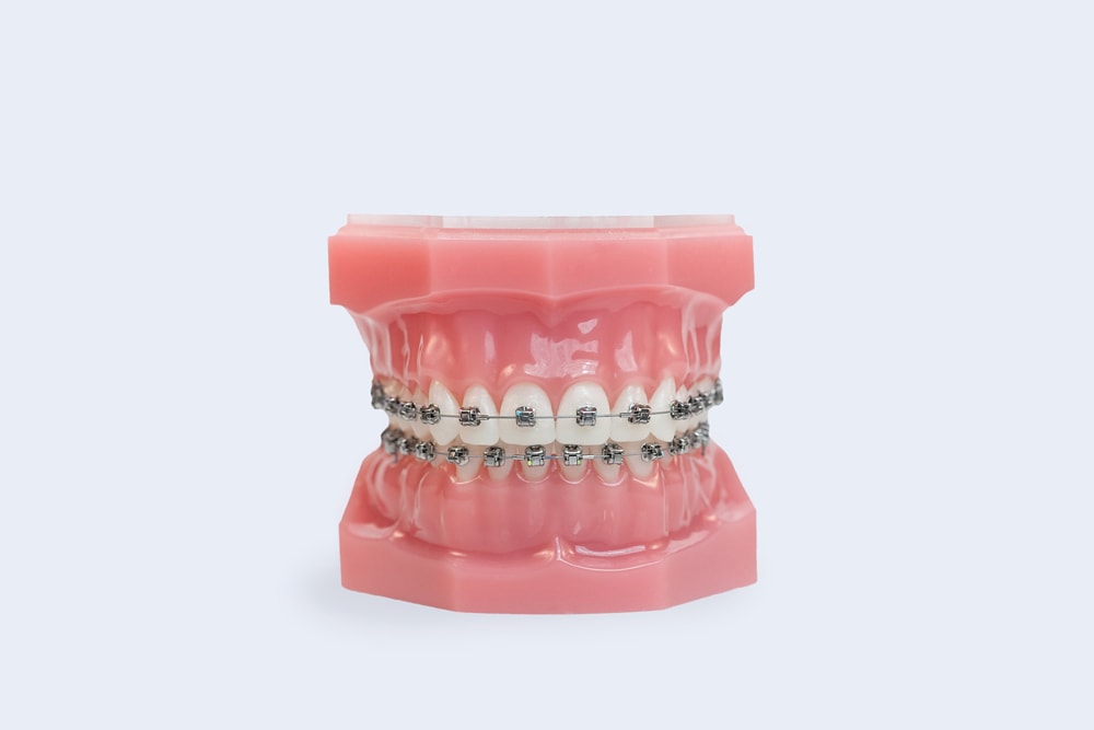 Metal Braces - Traditional Braces Cost - Kingston Orthodontics